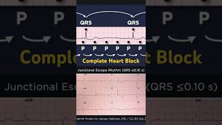 Third Degree Atrioventricular Block ECG Junctional Escape Rhythm [upl. by Illyes975]