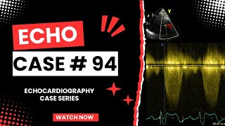 ECHO CASE 94  Echocardiography for Beginners  Echocardiogram Interpretation  2D Echo Basics [upl. by Iem]