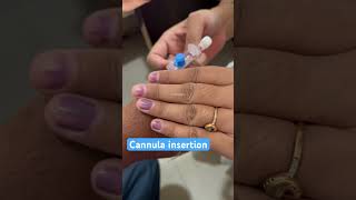 Cannula insertion of male patient on Thumb nurses cannula doctor neet mbbs bscnursing shorts [upl. by Perrins]