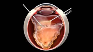 Retinal Detachment  Signs Symptoms and Treatment [upl. by Aliac]