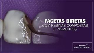 Facetas Diretas com Resinas Compostas e Pigmentos  Leonardo Muniz [upl. by Odnalro446]