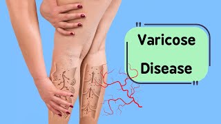 Varicose veins disease and its effect on health [upl. by Tamis12]