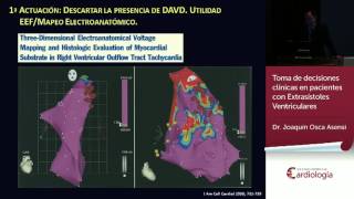 Toma de decisiones clínicas en pacientes con Extrasístoles Ventriculares [upl. by Ticon145]