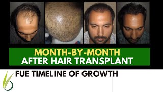 When Will Hair Grow after My Hair Transplant  Darling Buds [upl. by Auoh]