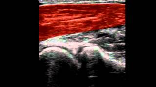 Musculoskeletal Ultrasound Elbow 1 anterior humeroradial longitudinal scan [upl. by Mcgee201]