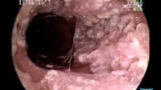 Endoscopic Imaging of Esophageal Verrucous Carcinoma [upl. by Gilles283]