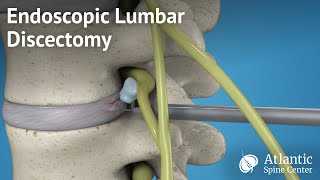 Endoscopic Lumbar Discectomy [upl. by Latsirc43]