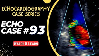 ECHO CASE 93  Echocardiography for Beginners  Echocardiogram Interpretation  2D Echo Basics [upl. by Nolie120]