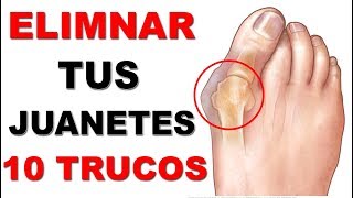 10 Trucos Infalibles Para Eliminar Los Juanetes QUITA los juanetes sin cirugía [upl. by Sherborne]