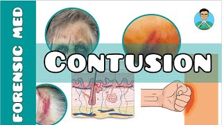 Contusion  What is a contusion injury  What causes of bruising  What are the types of bruises [upl. by Leo461]