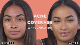 COVERING ACNE WITH FOUNDATION  FENTY BEAUTY [upl. by Olocin512]