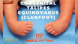 Congenital Talipes Equinovarus Clubfoot  part 1  Introduction  In Hindi  Mera Physio [upl. by Osmen390]