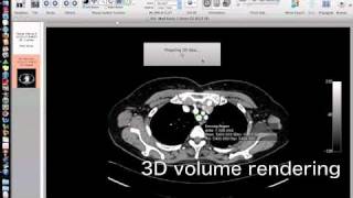 OsiriXsimulated Navigation S1lung segmentectomy [upl. by Sredna]