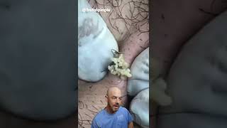 You aren’t ready for this cyst and ingrown hair combo👊💥 credit brufoilpimple doctorsatisfying [upl. by Ynaffad]