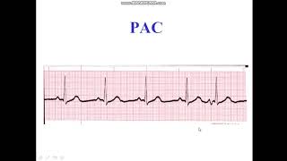 Premature Atrial Complex  Bigeminy  Trigeminy [upl. by Ahsiliw144]