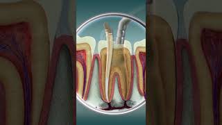 Root Canal Treatment  Curveia Dental I RCT [upl. by Clarette]