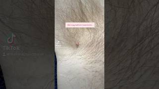 Skin Tag Removal before and after results skintagremoval [upl. by Narej]