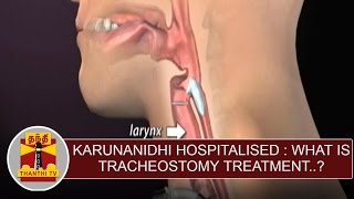 Karunanidhi Hospitalised  What is Tracheostomy treatment  Thanthi TV [upl. by Ellehc]