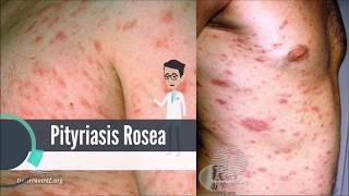 What is Pityriasis Rosea [upl. by Ernaline670]