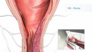 HAL RAR Procedure for the Treatment of Haemorrhoids and Piles [upl. by Camilia]