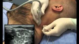 Interscalene Block ultrasound guided  in plane [upl. by Andrej]