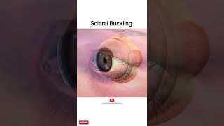 Scleral buckling  animation video [upl. by Nylaret430]