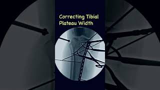 Correcting tibial plateau width in proximal tibia fractures ortho justortho trauma fracture [upl. by Serolod]