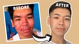 PAANO MAWALA ANG PIMPLES SUPER LEGIT  Isotretinoin review Philippines  Tips amp tricks for pimples [upl. by Asli]