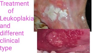 Treatment of LeukoplakiaTypes of Leukoplakia Different treatment modalities of Leukoplakia PVLVH [upl. by Nylatsirk85]