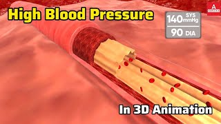 High Blood Pressure Explained in 3D  Understanding Hypertension [upl. by Syned551]