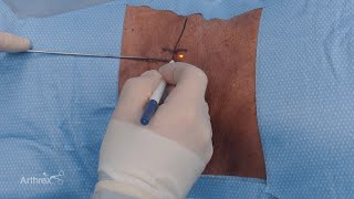 Endoscopic Approach to Transforaminal Discectomy [upl. by Florian]