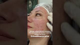 Mesogel Jalupro injection technique skin rejuvenation lifting effect and improvement of skin color [upl. by Sabian244]