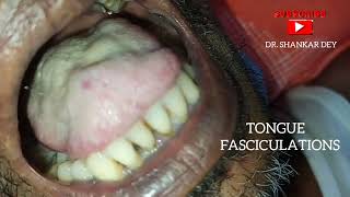 Tongue Fasciculations  Motor Neuron Disease  Amyotrophic Lateral Sclerosis  Dr Shankar Dey [upl. by Semajwerdna]