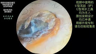 Fungal cleaning of dry slices in the ear canal [upl. by Katalin645]