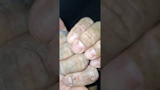 Scratching eczema satisfying eczema asmr scratch [upl. by Nali504]