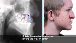 Treatment planning and soft tissue prediction 9 with Facad software [upl. by Gardas831]