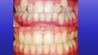 Amazing Orthodontics Treatment  Canines on Top [upl. by Henrion547]