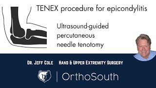 TENEX Procedure for Epicondylitis tennis and golfers elbowDr Jeff ColeOrthoSouth [upl. by Naujet]