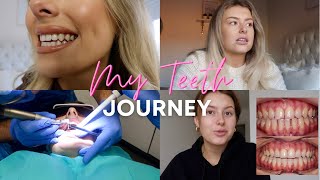 MY TEETH JOURNEY  Braces Whitening Composite bondingI talk about everything [upl. by Nataniel]