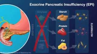 Exocrine Pancreatic Insufficiency [upl. by Akemehc49]