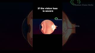 Treatment of Optic Neuritis [upl. by Suinotna]