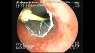 Positioning without fluorscopic esophageal SEMS [upl. by Kram]