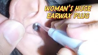 Womans Huge Earwax Plug Removed without Applying Earwax Softener [upl. by Lashoh145]