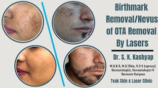 Birthmark RemovalNevus of OTA Removal By Lasers  Tvak Skin amp Laser Clinic  New Delhi [upl. by Leribag703]