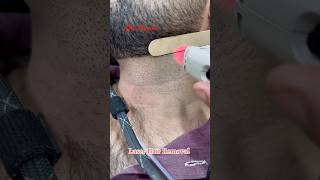 Laser Hair Removal Treatment getsmarthairclub hair viralvideo hairremoval [upl. by Hgieloj]