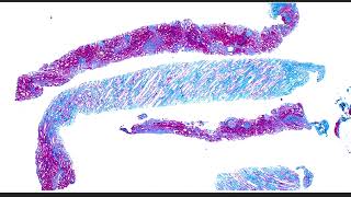 Collidescope Ep 1  What happens when IgA nephropathy and fibrillary glomerulopathy collide [upl. by Iggem]