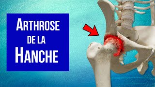 Arthrose de la hanche  Explication et Traitement [upl. by Malcom]