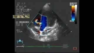 muscular ventricular septal defectVSD [upl. by Stichter]