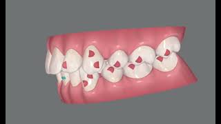 Extraction of four premolars Invisalign Clincheck case simulation [upl. by Bolger]