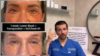 Recovery after a lower blepharoplasty [upl. by Donahue]